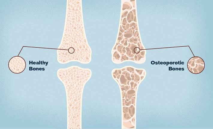 The Silent Fragility Crisis: Why Bone Mineral Density (BMD) Is the Overlooked Longevity Biomarker for Denver Athletes & Active Adults